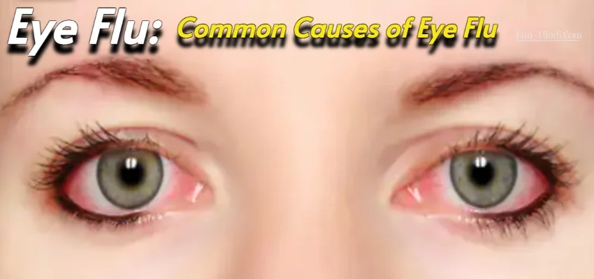 Eye Flu Symptoms, Causes, and Treatment
