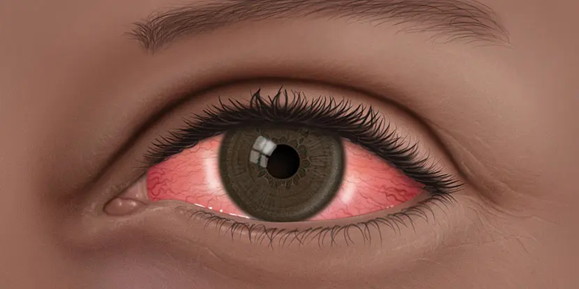 How to Cure Pink Eye at Home Fast