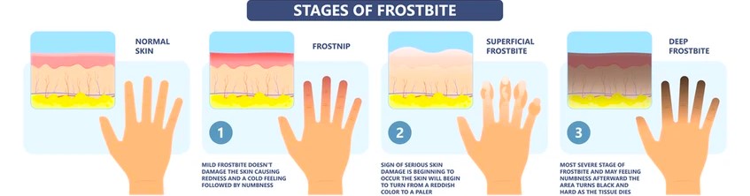 Symptoms, Prevention, Treatment Due To Frostbite/Cold Injury
