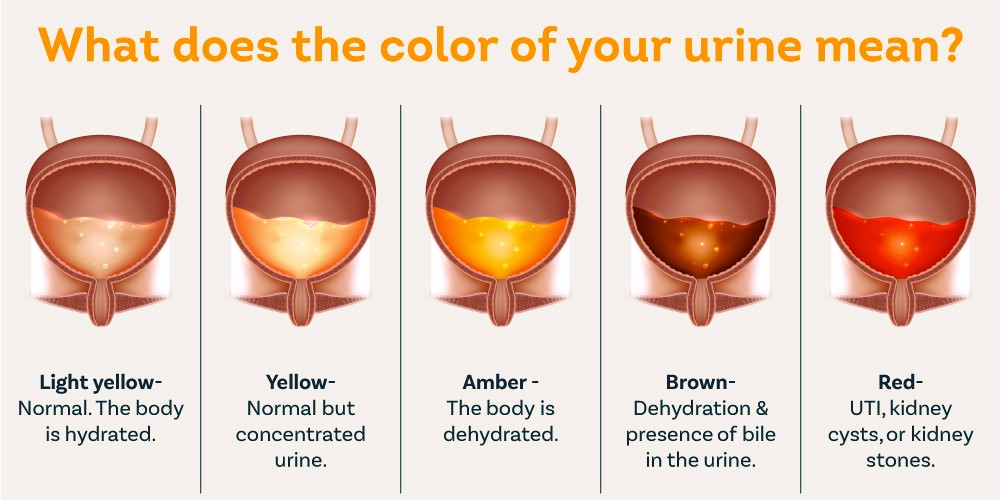 Hematuria: Causes, Symptoms, Prevention, and Treatment of Blood in Urine