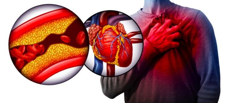 Symptoms, Prevention, and Treatment of Heart Attack