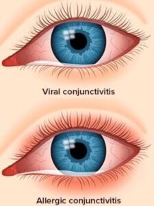 Can Eye Flu Cause Fever Viral Eye Flu 2023